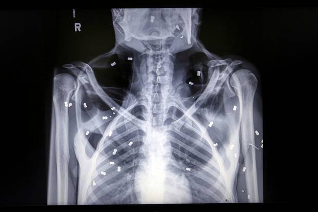 X-ray image of air rifle pellets inside the body of a female orangutan named Hope. The endangered orangutan had a young baby that died from malnutrition. Photo / AP